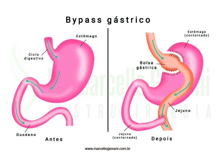 Tudo Sobre A Cirurgia Bari Trica Bypass Cl Nica Dr Marcello Giovani