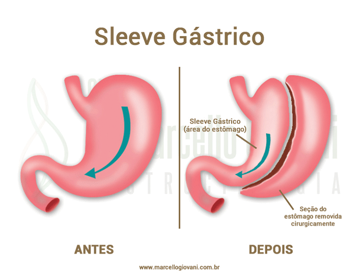 Cirurgia Bariátrica Sleeve - Dr Marcello Giovani - Gastrocirurgia